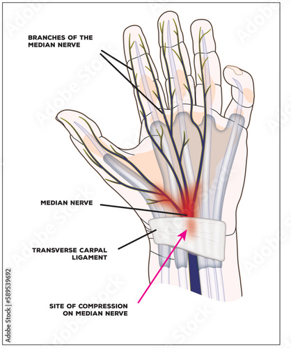 Site of compression of the median nerve in carpal tunnel syndrome