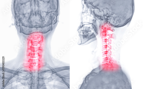 X-ray C-spine or x-ray image of Cervical spine AP and Lateral view for diagnostic intervertebral disc herniation ,Spondylosis and fracture.
