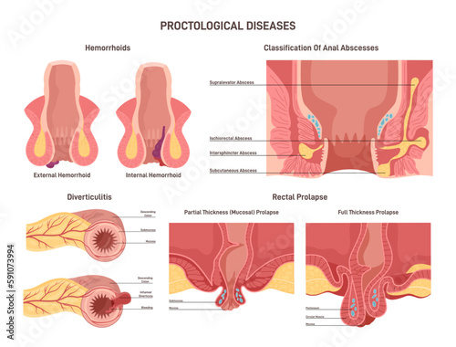 Proctological diseases set. Large intestine and rectum disorders