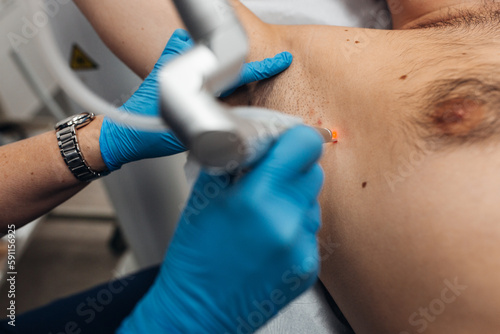 Laser removal of warts on the body in the clinic