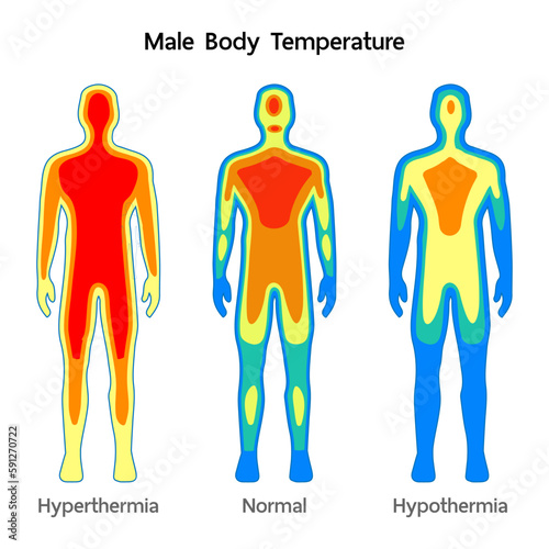 Male body Temperature model Normal, Hyperthermia and hypothermia health care infographic. Vector flat healthcare illustration. Body cooling infrared heat map isolated on white background.