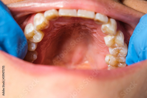 Close-up of the upper jaw, hard palate, soft palate, teeth and gums of a middle-aged woman.