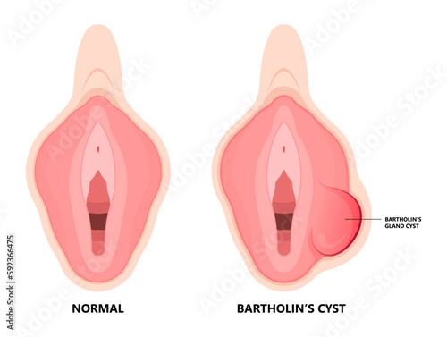 Bartholin’s cyst of vagina pain lump mass with E. coli bacteria sex safe pelvic exam cervix swollen pus lips vulva blockage