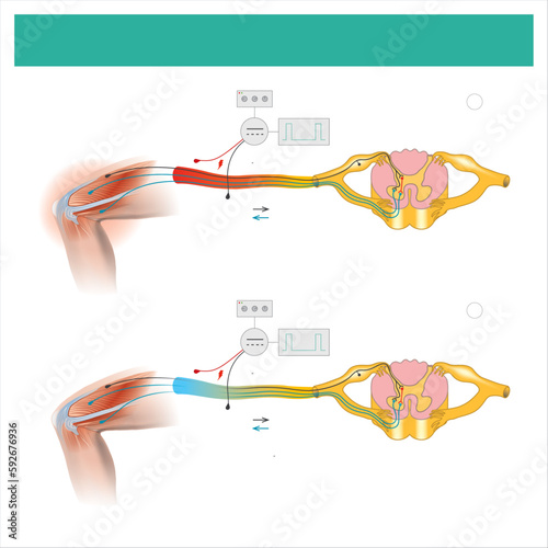 Epidural Electrical Stimulation. Muscle pain symptom in the leg area and treatment by electrical stimulation on skin and then passed the leg muscles and nerves..