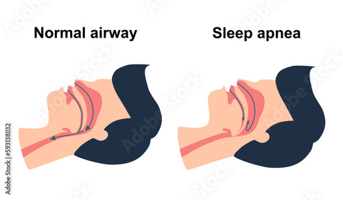 Obstructive sleep apnea syndrome concept vector illustration.