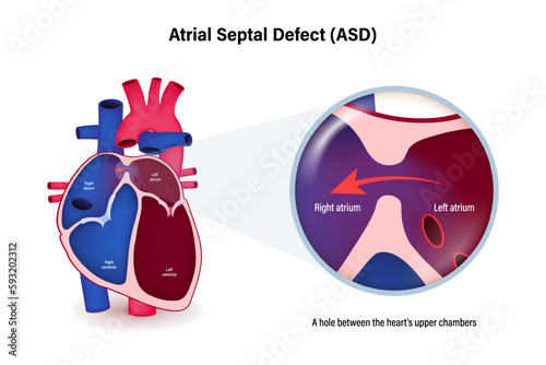 Atrial septal defect (ASD) vector. Congenital heart defect.