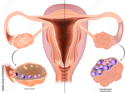 Controlled Ovarian Stimulation COS or Controlled ovarian hyperstimulation COH for IVF. Selecting the ideal protocol