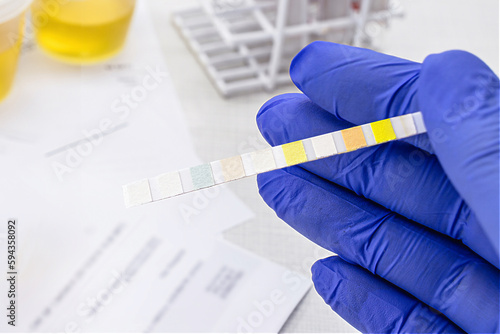 urinalysis with reagent strips to analyze Leukocytes, Urobilinogen, Bilirubin, Blood, Nitrite, pH, Density, Protein, Glucose and Ketosis bodies.