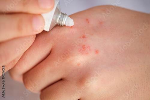 Woman applying white medical corticosteroid ointment on eczema on her hand. Dermatitis, allergy, psoriasis concept.