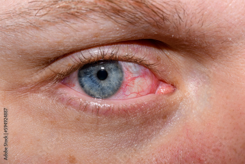 Niebieskie otwarte oko z zapaleniem spojówek 
