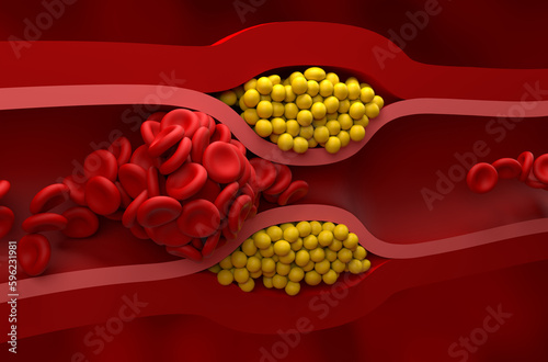 Fully blocked vessel in high level of LDL (bad cholesterol) lipoprotein – Closeup view 3d illustration