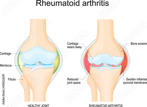 Rheumatoid arthritis of a knee joint