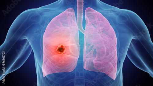 3d medical illustration of lung cancer