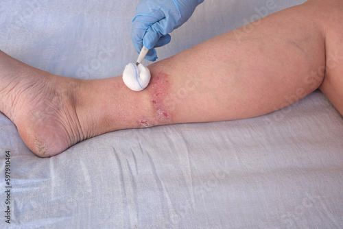 doctor treats large healing wound from on lower leg with scars of adult female patient, redness, scarring of skin, concept of medical care, health care, human tissue regeneration, scald on women feet