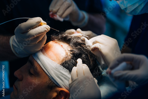 Hair Transplant Operation Process with Surgeon.