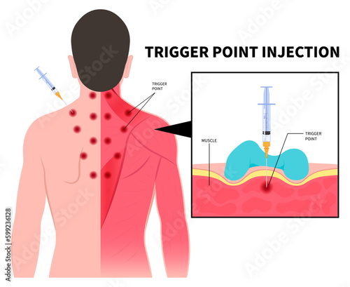 Trigger Point Pain Syndrome Fibromyalgia Gluteus Medius Anatomy and Myofascial Muscle Trauma Office Strain calf hip knee arm or Capitis Fascia Shock Wave fibers shots of Taut Band spasm Sport relieve