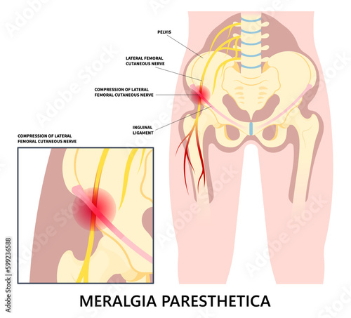 Hip sciatica bursitis pain Leg Injury and IT Band Syndrome or Meralgia Paresthetica compressed spine tingling numbness thigh pinched nerve