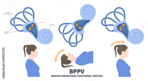Semicircular Meniere’s Ear Canal Benign Paroxysmal Positional vertigo or BPPV loss balance dizzy Electronystagmography treat Canalith repositioning procedure otoconia calcium carbonate crystal brain