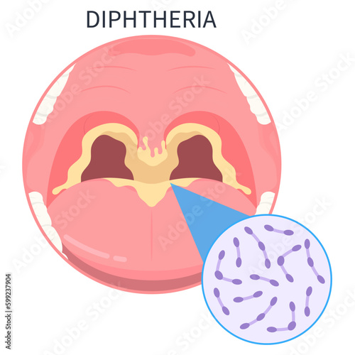 Diphtheria vaccine of group A with the tetanus croup strep throat bacterial