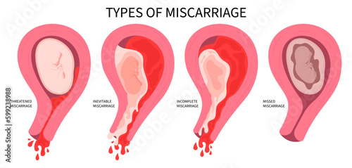 Miscarriage abortion loss pregnancy stillbirth implantation bleeding ectopic Vaginal baby period conception D&C and cervix pain obstetric Gynaecological birth early Cervical Cerclage pregnant
