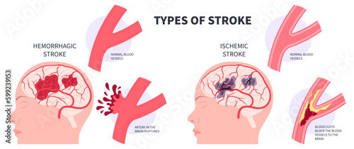 Alzheimer's dementia brain Signs symptom of Stroke vascular Hemorrhagic transient ischemic attack or TIA arm face pill memory damage frontal lobe heart mini risk care blockages High Fatty deposits