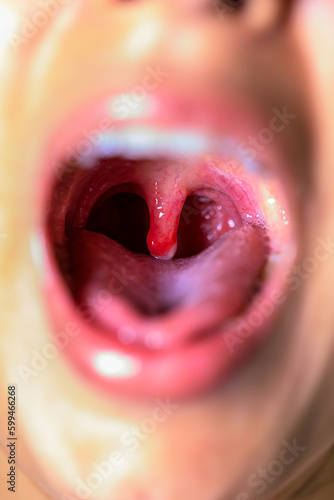 open wide mouth with swollen uvula showing inside
