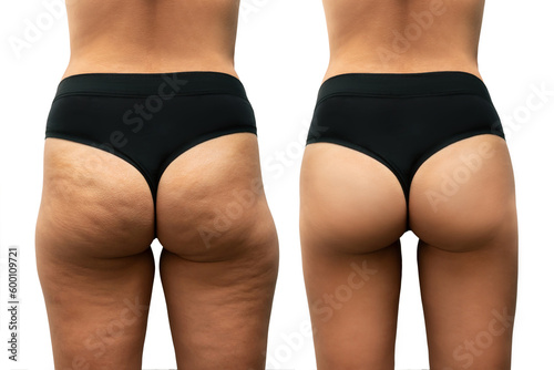 Young tanned woman's thighs and buttocks with cellulite before and after treatment on white background. Getting rid of excess weight. Result of diet, sports, massage. Improving the skin on legs