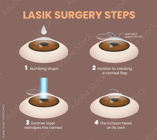 illustration of lasik eye surgery steps