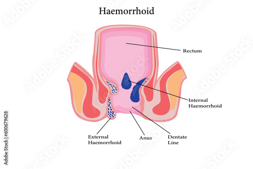 Cross section of the rectum and anal canal. illustration of hemorrhoids structure. vector eps 10