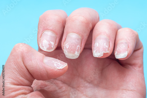 Flaky bitten and brittle nails without a manicure. Regrown nail cuticle and damaged nail plate after gel polish on blue background.