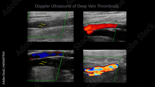 Color Doppler ultrasound determination in deep vein thrombosis patients for finding deep vein thrombosis of lower extremity.