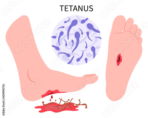 Foot injury with Tetanus infection bacteria Clostridium tetani virus bacterial toxin lockjaw Vaccination and vaccine prevention Stepped on a Nail trauma