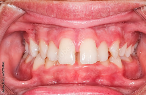 Dental maxillary and mandibular arches in occlusion with biting teeth, diastema gap between central incisors. Healthy gingival gum and no decay. 