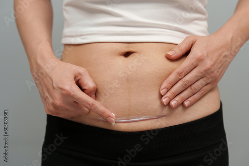 woman putting healing cream in c-section scar of cesarean