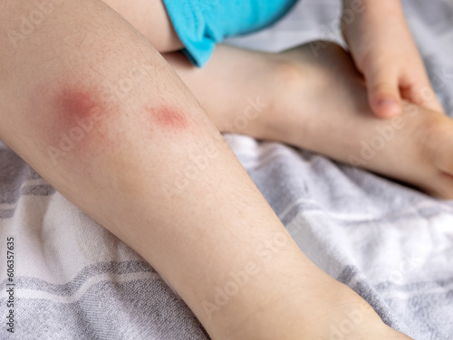 kid child boy legs with mosquito bite big red spots.baby hand scratching the skin.father use spray anti mosquitos bites and capua.summertime consequences of walking in park.pain and inflammation