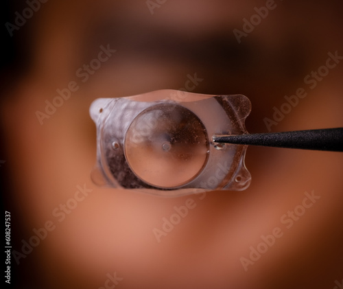 photo of Implantable Collamer Lens ICL for treating refractive errors, infront of a human eye