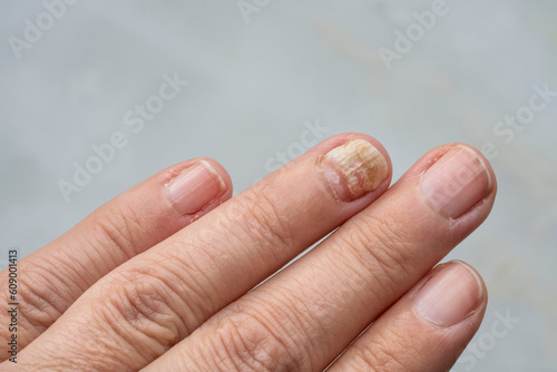 hand finger nail with fungal infection