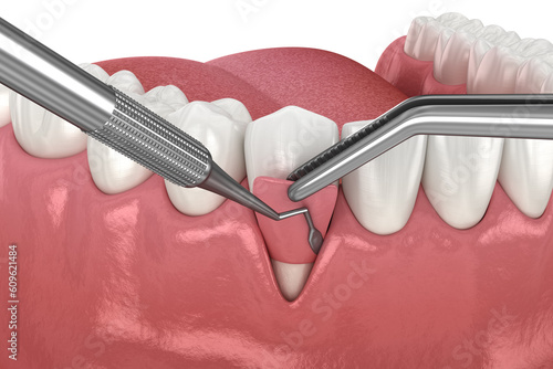 Gingiva Recession: Soft tissue graft surgery. 3D illustration of Dental treatment