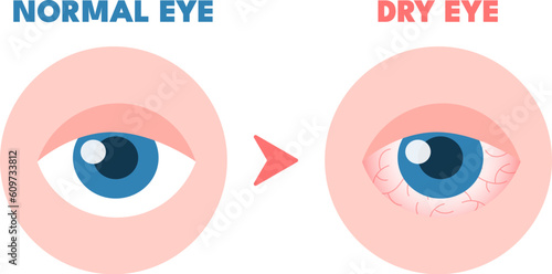 Dry eyes. Healthy unhealthy red eye, driing astonished redness irritated surface eyeball, conjunctivitis glaucoma disease or lens allergies