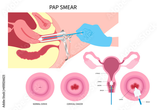 cervix cancer and Examine in women female with obstetric swab vulvar warts prevent by Pap smear test procedure the HPV cervical diagnostic of loop excision sex or LEEP cell cone cytology care screen