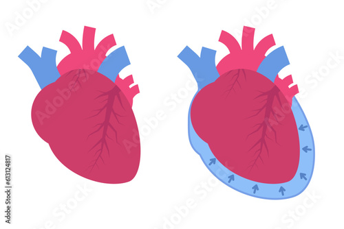 Pericardial effusion concept. Cardiovascular system medical vector illustration.