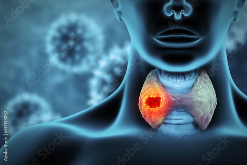 Thyroid gland cancer. showing thyroid gland with tumor. 3d illustration