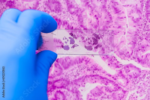 Scientist in blue gloves hand holding glasses slide breast tissue on out of focus cancer tissue picture background.Pathologist hand in glove holding glass organ samples.Histological examination.