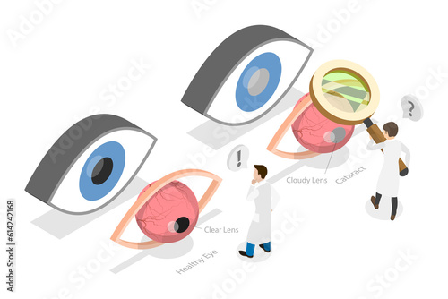 3D Isometric Flat Conceptual Illustration of Cataract