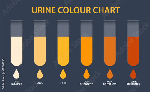 Urine colour chart. Hydration and dehydration level diagram. Medical urinal test kit for urinary tract infection research. Containers with yellow to brown pee for urinalysis. Vector illustration