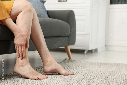 Barefoot woman with varicose veins on sofa in room, closeup