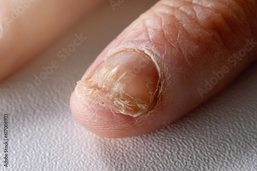 fungal infection. nail fungus candida on hand fingernail