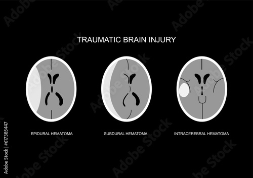 Illustration of common CT imaging following traumatic brain injury. Epidural hematoma, acute subdural hematoma and intra-cerebral hematoma.