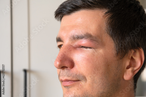 A red swollen eyelid on a man's face in close-up is an allergy to an insect bite. Allergic reaction to blood-sucking insects