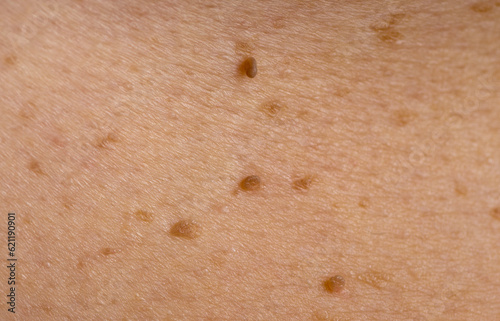 Nevus close-up. Mole on human skin. Irregular birthmark.